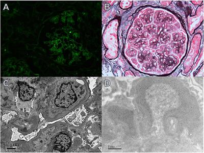 Case Report: Lenalidomide as a Second-Line Treatment for Bortezomib-Ineffective Nephrotic Syndrome Caused by LCDD: 2 Case Reports and a Literature Review